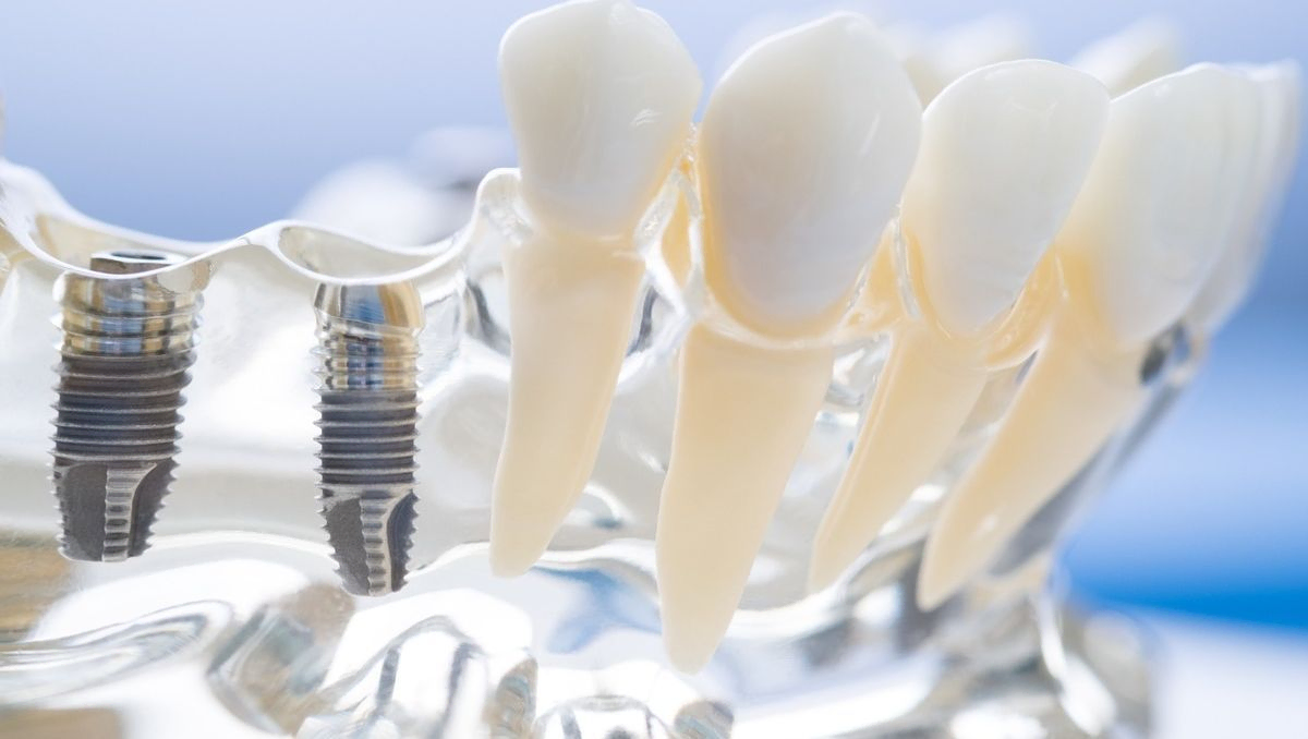 detalle dientes protesis dental