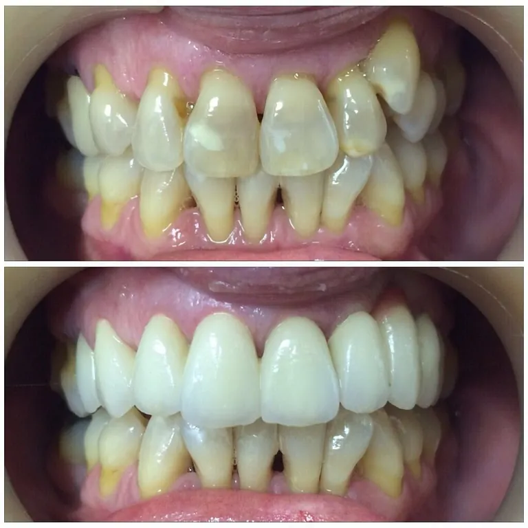 NATURAL TEETH SL. Dientes 1
