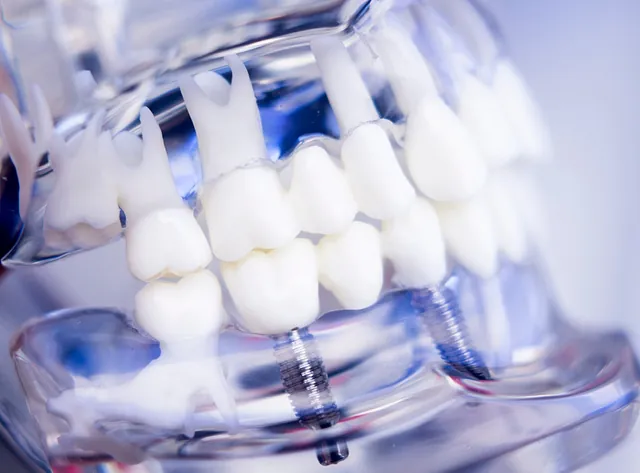 detalle protesis dental